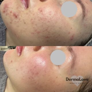 Tato krásná proměna je za tři měsíce a to pouze díky čištění pleti v salonu. 🥳 díky tomu lze vidět to, že pravidelná...