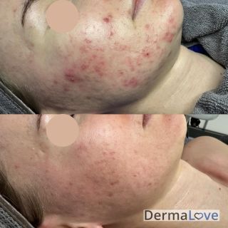 👉 Jak jsme těchto nádherných výsledků s klientkou dosáhly? 👉 Při vstupní konzultaci jsem pleť hloubkově pročistila a...